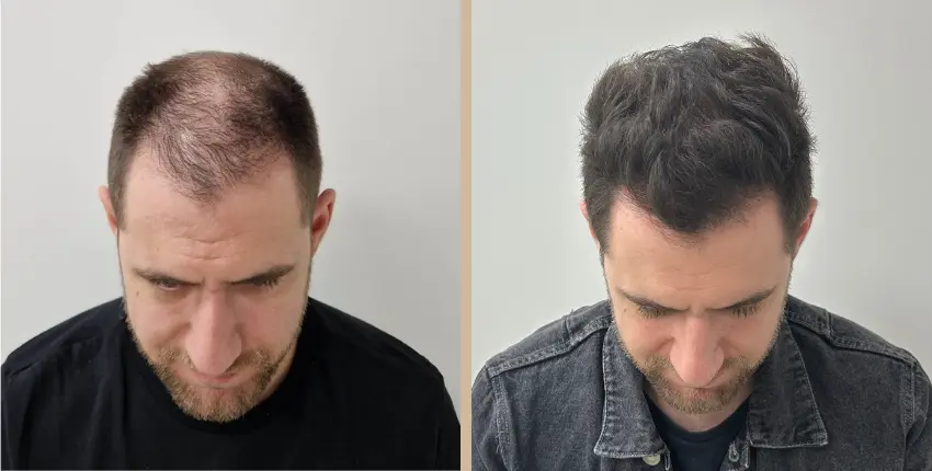 hajbeültetés Debrecen before-after