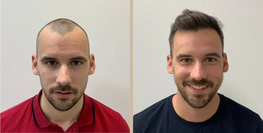 hajbeültetés Debrecen before-after