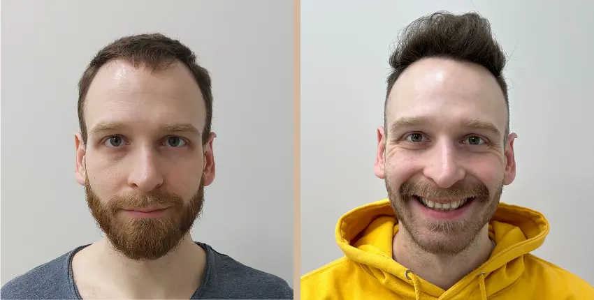 hajbeültetés Debrecen before-after