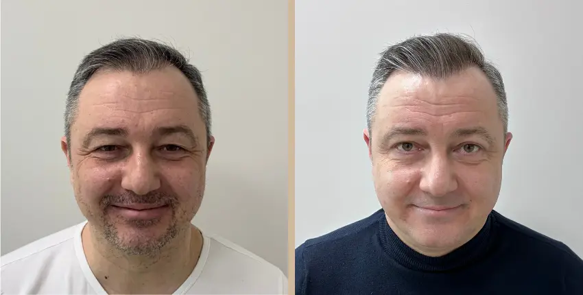 hajbeültetés Debrecen before-after